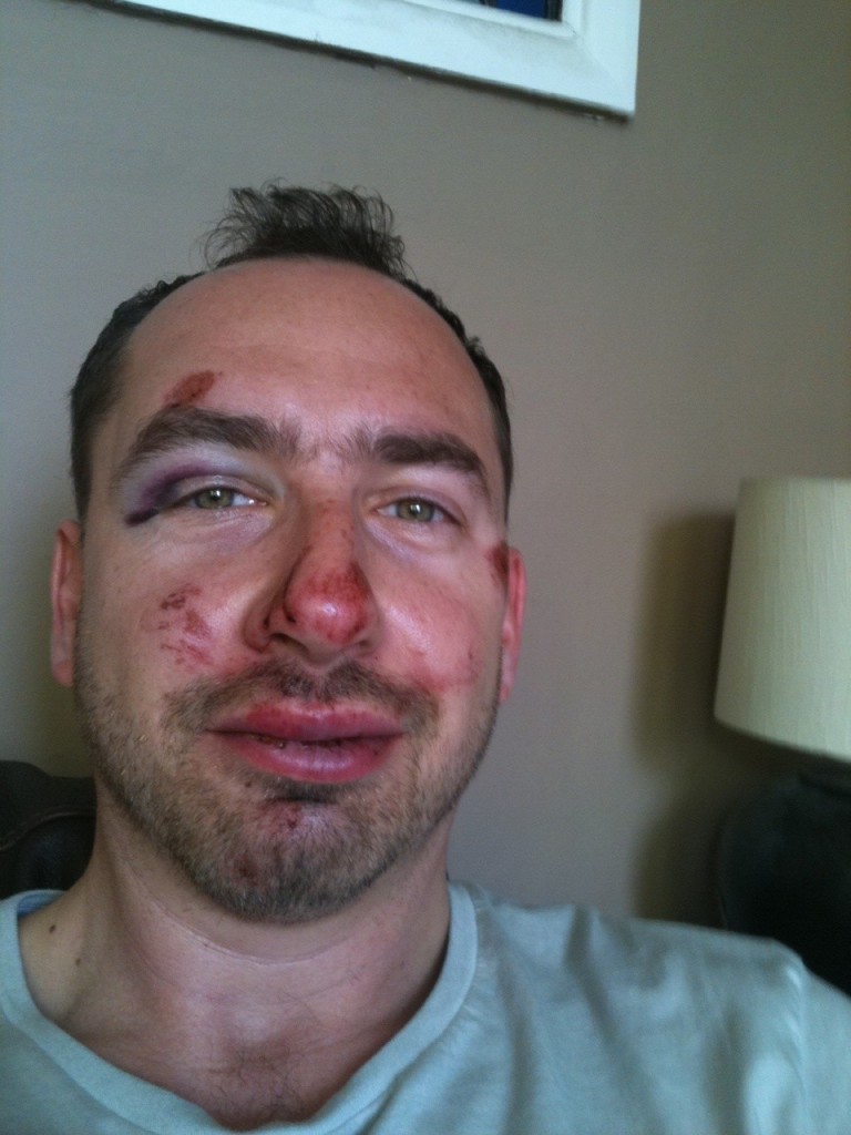saul bike crash 1